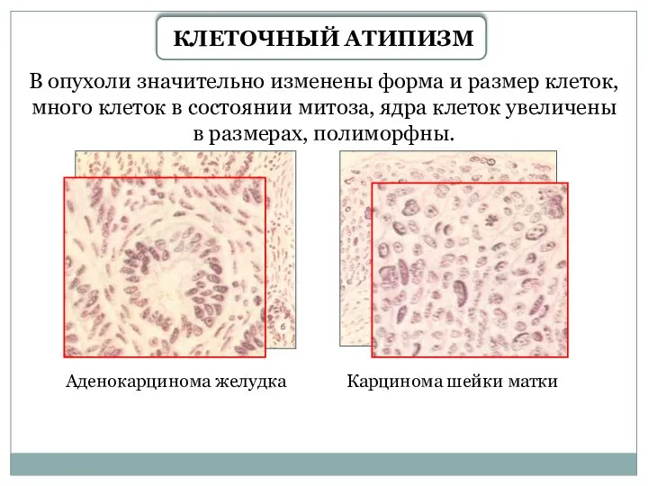 КЛЕТОЧНЫЙ АТИПИЗМ В опухоли значительно изменены форма и размер клеток, много клеток