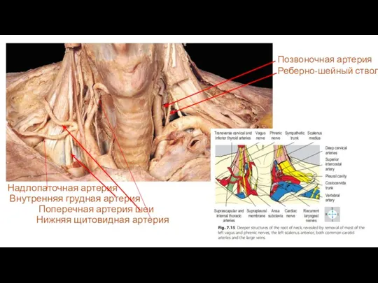 Надлопаточная артерия Внутренняя грудная артерия Поперечная артерия шеи Нижняя щитовидная артерия Позвоночная артерия Реберно-шейный ствол
