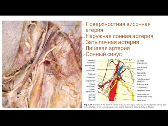 Поверхностная височная атерия Наружная сонная артерия Затылочная артерия Лицевая артерия Сонный синус ВСА НСА