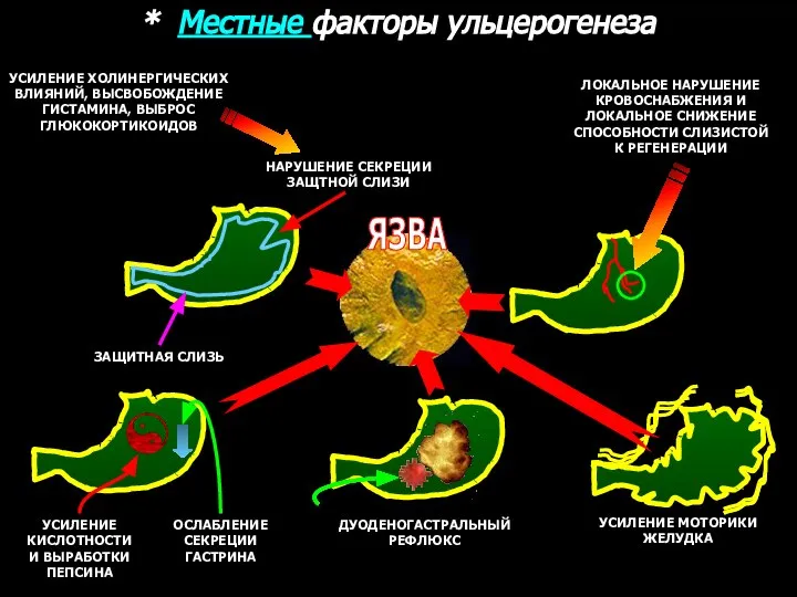 * Местные факторы ульцерогенеза ЗАЩИТНАЯ СЛИЗЬ НАРУШЕНИЕ СЕКРЕЦИИ ЗАЩТНОЙ СЛИЗИ УСИЛЕНИЕ ХОЛИНЕРГИЧЕСКИХ