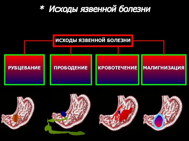 ИСХОДЫ ЯЗВЕННОЙ БОЛЕЗНИ РУБЦЕВАНИЕ ПРОБОДЕНИЕ КРОВОТЕЧЕНИЕ МАЛИГНИЗАЦИЯ * Исходы язвенной болезни