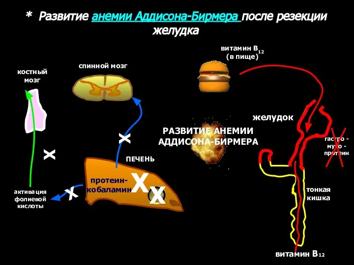 * Развитие анемии Аддисона-Бирмера после резекции желудка ПЕЧЕНЬ витамин В12 (в пище)