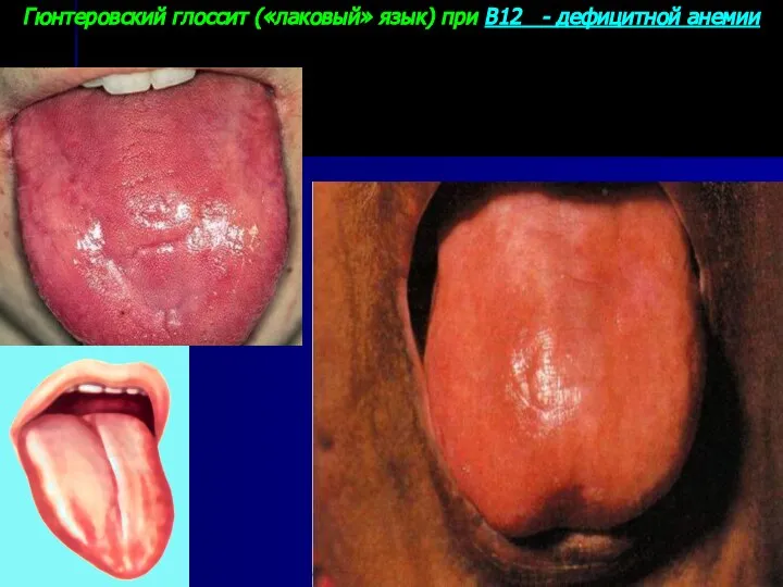 Гюнтеровский глоссит («лаковый» язык) при В12 - дефицитной анемии 17