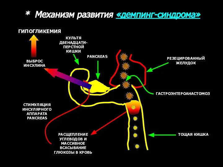 * Механизм развития «демпинг-синдрома» РЕЗЕЦИРОВАННЫЙ ЖЕЛУДОК КУЛЬТЯ ДВЕНАДЦАТИ- ПЕРСТНОЙ КИШКИ PANCREAS ТОЩАЯ