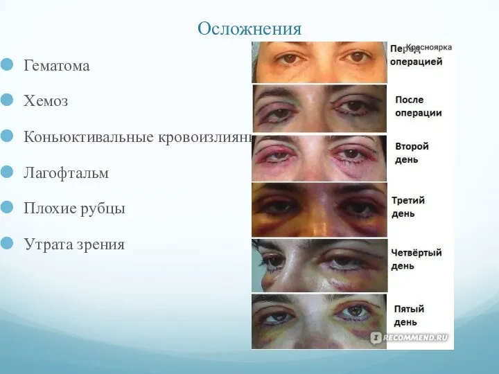 Осложнения Гематома Хемоз Коньюктивальные кровоизлияния Лагофтальм Плохие рубцы Утрата зрения