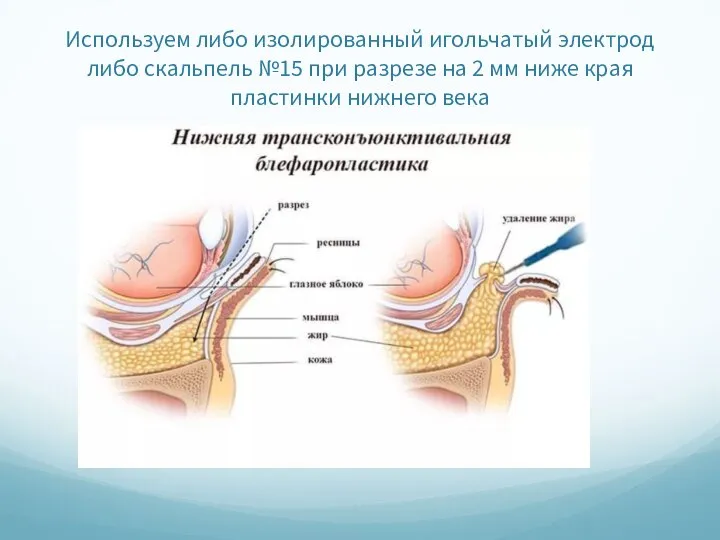 Используем либо изолированный игольчатый электрод либо скальпель №15 при разрезе на 2