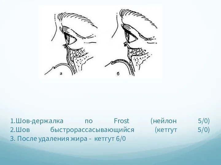 1.Шов-держалка по Frost (нейлон 5/0) 2.Шов быстрорассасывающийся (кетгут 5/0) 3. После удаления жира - кетгут 6/0