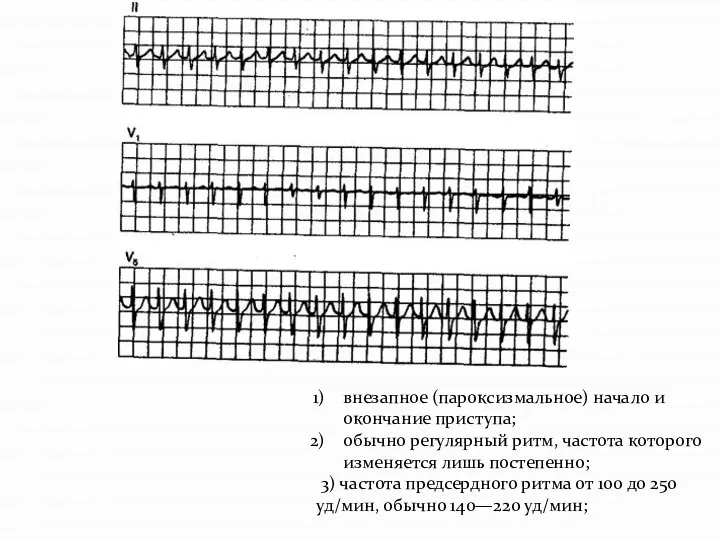 внезапное (пароксизмальное) начало и окончание приступа; обычно регулярный ритм, частота которого изменяется