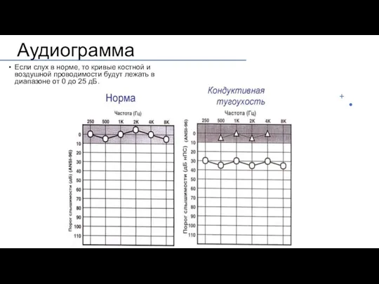 Аудиограмма Если слух в норме, то кривые костной и воздушной проводимости будут