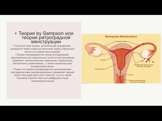 Теория by Sampson или теория ретроградной менструации Согласно этой теории, эутопический эндометрий