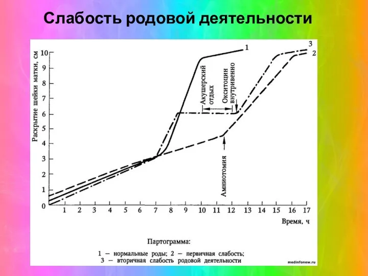 Слабость родовой деятельности