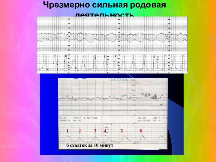 Чрезмерно сильная родовая деятельность