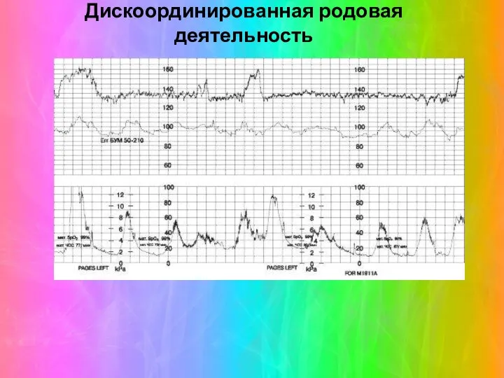 Дискоординированная родовая деятельность