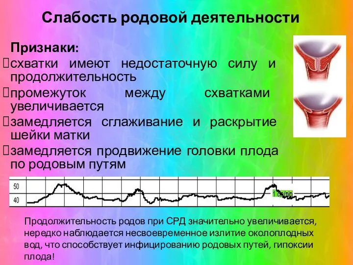 Слабость родовой деятельности Признаки: схватки имеют недостаточную силу и продолжительность промежуток между