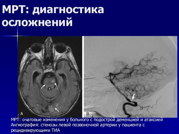 МРТ: диагностика осложнений МРТ: очаговые изменения у больного с подострой деменцией и