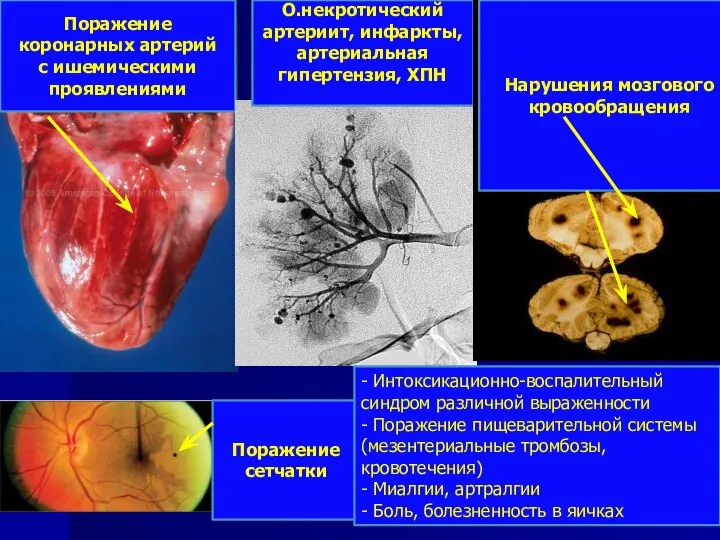 Поражение коронарных артерий с ишемическими проявлениями О.некротический артериит, инфаркты, артериальная гипертензия, ХПН