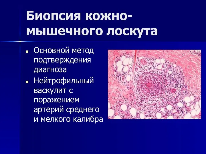 Биопсия кожно-мышечного лоскута Основной метод подтверждения диагноза Нейтрофильный васкулит с поражением артерий среднего и мелкого калибра