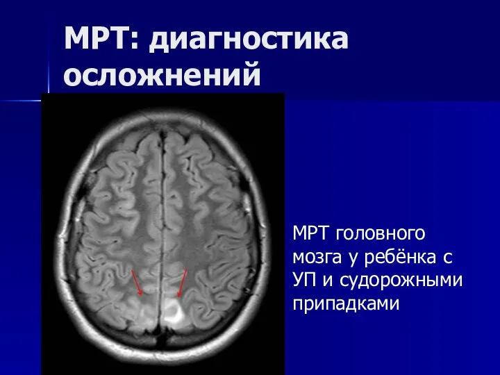 МРТ: диагностика осложнений МРТ головного мозга у ребёнка с УП и судорожными припадками