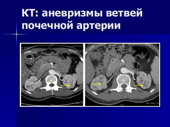КТ: аневризмы ветвей почечной артерии