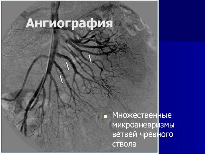 Ангиография Множественные микроаневризмы ветвей чревного ствола