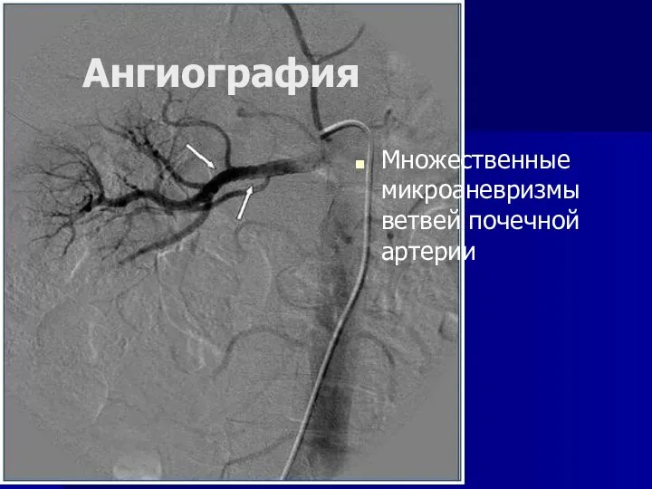 Ангиография Множественные микроаневризмы ветвей почечной артерии