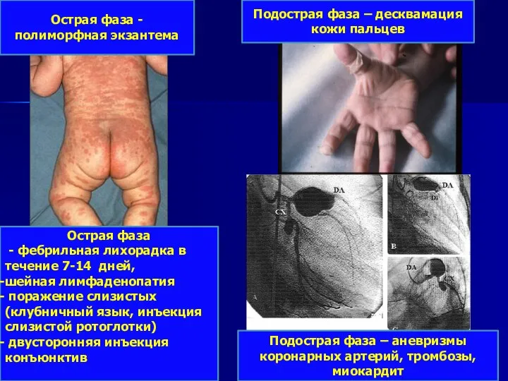 Острая фаза - полиморфная экзантема Подострая фаза – десквамация кожи пальцев Подострая