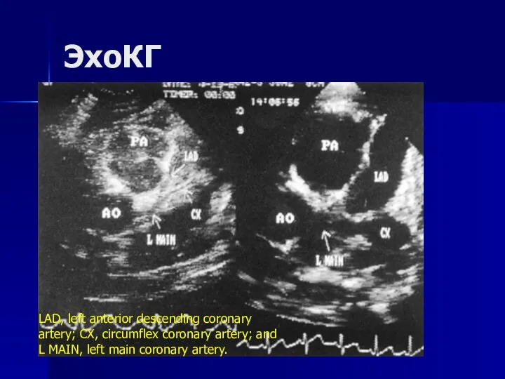 ЭхоКГ LAD, left anterior descending coronary artery; CX, circumflex coronary artery; and