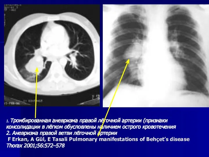 1. Тромбированная аневризма правой лёгочной артерии (признаки консолидации в лёгком обусловлены наличием