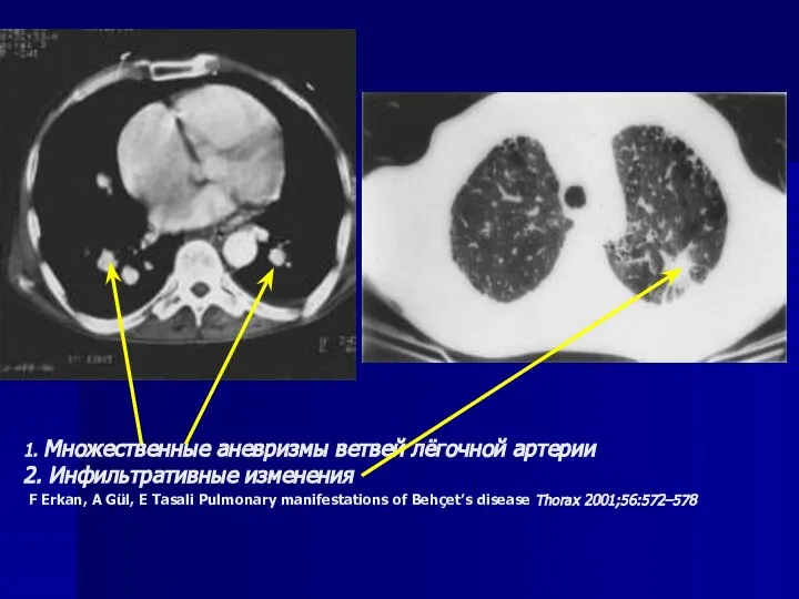 1. Множественные аневризмы ветвей лёгочной артерии 2. Инфильтративные изменения F Erkan, A