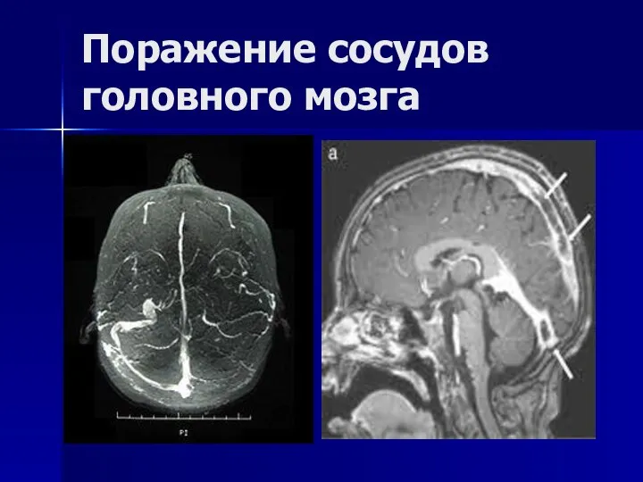 Поражение сосудов головного мозга