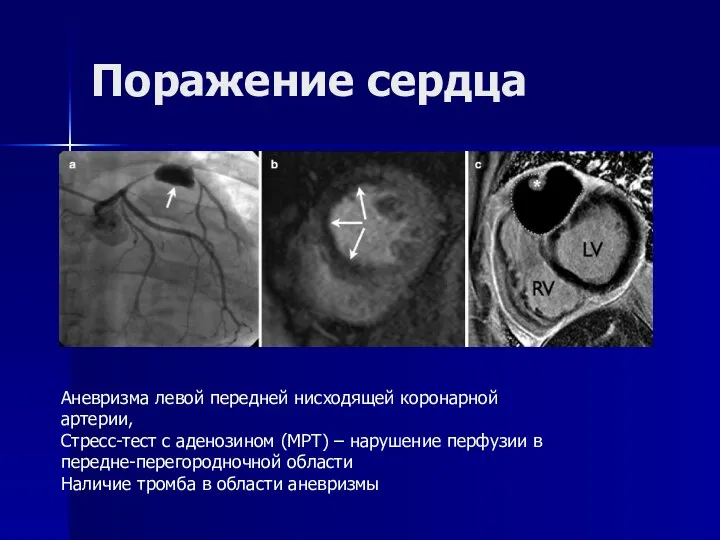 Поражение сердца Аневризма левой передней нисходящей коронарной артерии, Стресс-тест с аденозином (МРТ)
