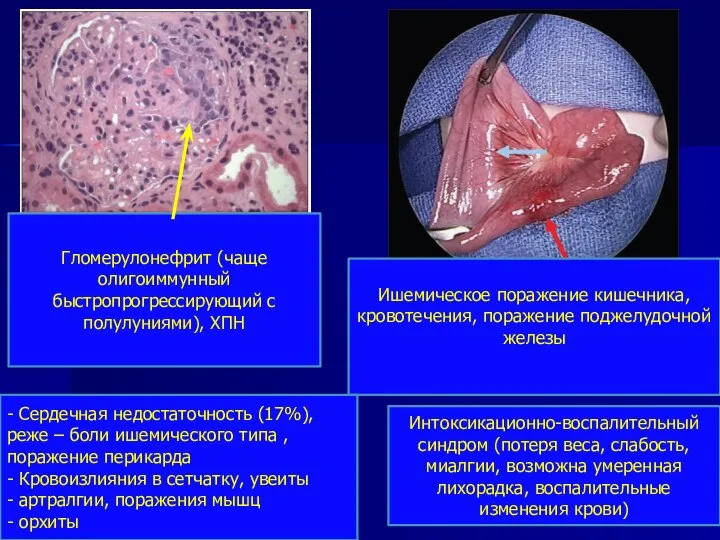 Гломерулонефрит (чаще олигоиммунный быстропрогрессирующий с полулуниями), ХПН Ишемическое поражение кишечника, кровотечения, поражение