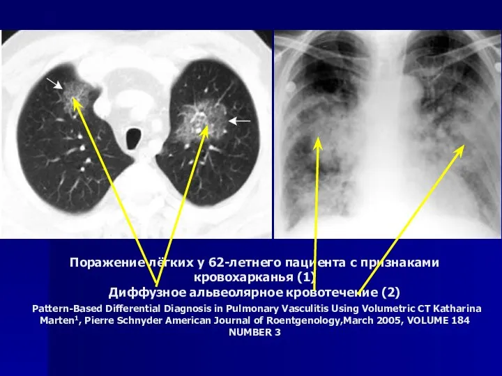 Поражение лёгких у 62-летнего пациента с признаками кровохарканья (1) Диффузное альвеолярное кровотечение