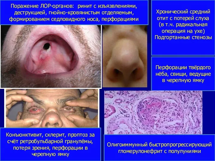 Поражение ЛОР-органов: ринит с изъязвлениями, деструкцией, гнойно-кровянистым отделяемым, формированием седловидного носа, перфорациями