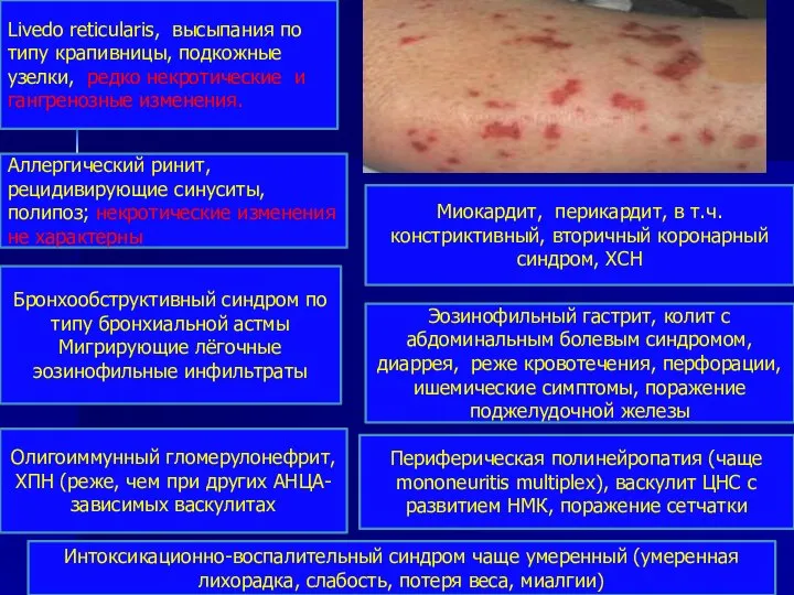 Livedo reticularis, высыпания по типу крапивницы, подкожные узелки, редко некротические и гангренозные