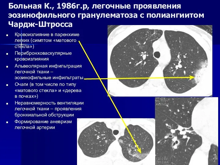 Больная К., 1986г.р, легочные проявления эозинофильного гранулематоза с полиангиитом Чардж-Штросса Кровоизлияние в