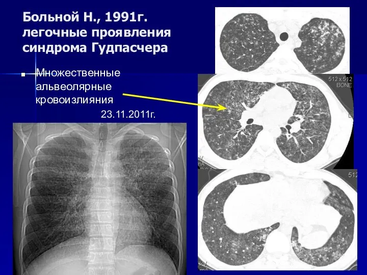 Больной Н., 1991г. легочные проявления синдрома Гудпасчера Множественные альвеолярные кровоизлияния 23.11.2011г.