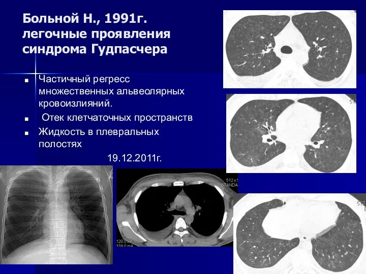 Больной Н., 1991г. легочные проявления синдрома Гудпасчера Частичный регресс множественных альвеолярных кровоизлияний.