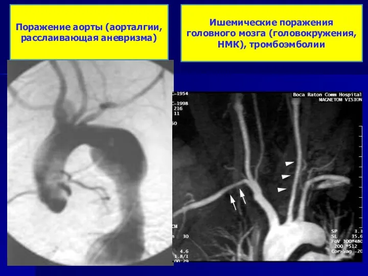 Поражение аорты (аорталгии, расслаивающая аневризма) Ишемические поражения головного мозга (головокружения, НМК), тромбоэмболии