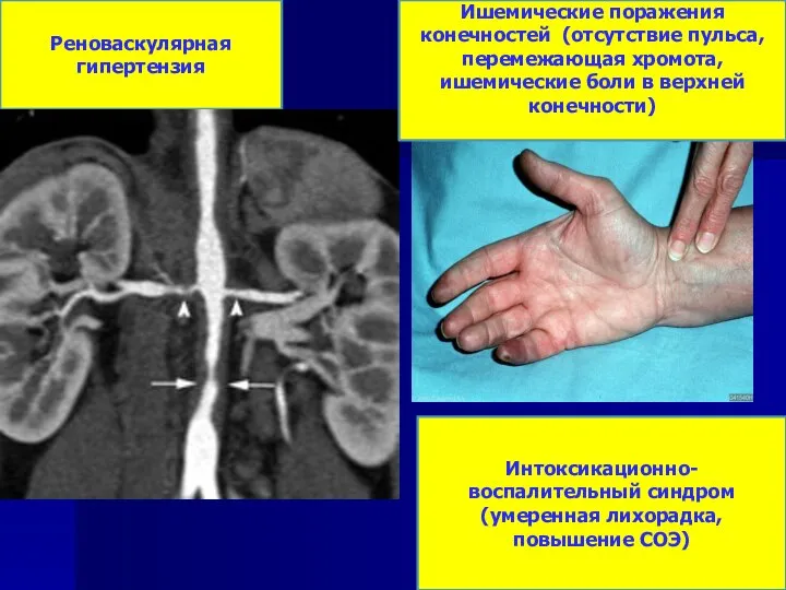 Реноваскулярная гипертензия Ишемические поражения конечностей (отсутствие пульса, перемежающая хромота, ишемические боли в