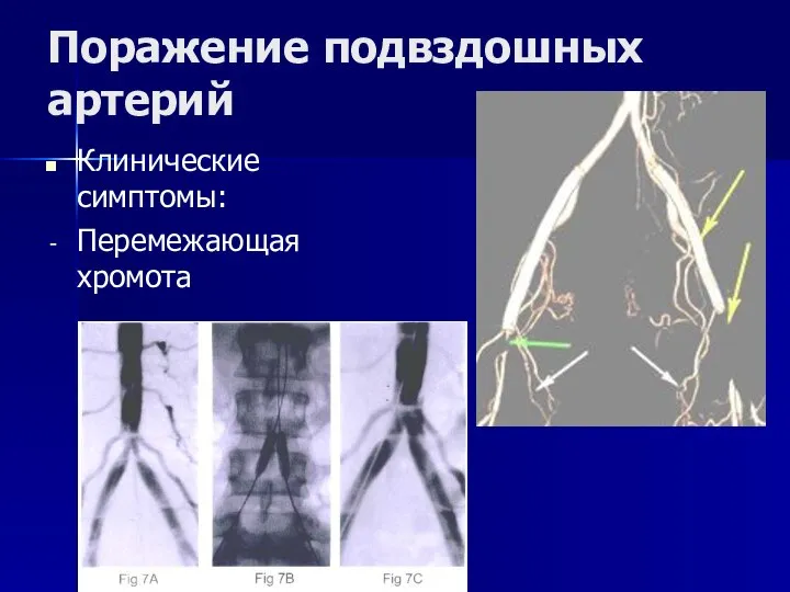 Поражение подвздошных артерий Клинические симптомы: Перемежающая хромота