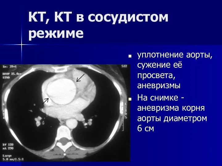 КТ, КТ в сосудистом режиме уплотнение аорты, сужение её просвета, аневризмы На