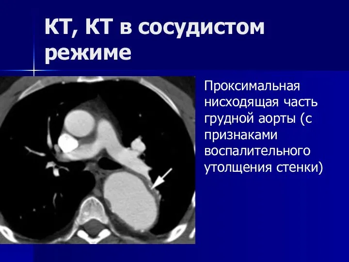 КТ, КТ в сосудистом режиме Проксимальная нисходящая часть грудной аорты (с признаками воспалительного утолщения стенки)