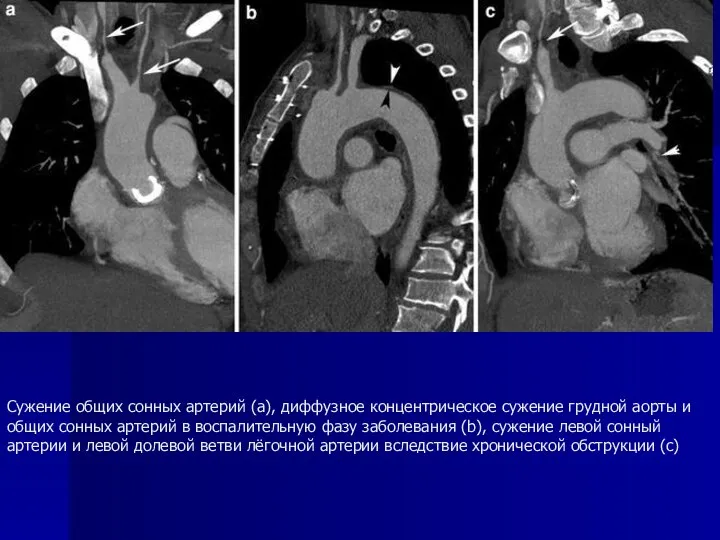 Сужение общих сонных артерий (а), диффузное концентрическое сужение грудной аорты и общих