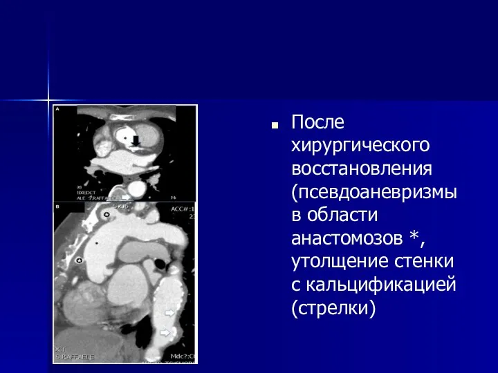 После хирургического восстановления (псевдоаневризмы в области анастомозов *, утолщение стенки с кальцификацией (стрелки)