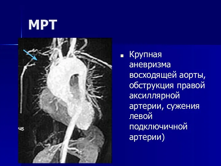 МРТ Крупная аневризма восходящей аорты, обструкция правой аксиллярной артерии, сужения левой подключичной артерии)