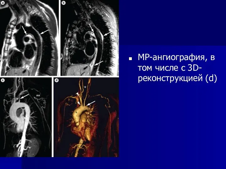 МР-ангиография, в том числе с 3D-реконструкцией (d)