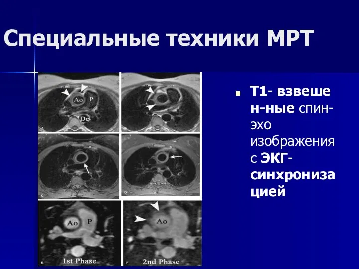 Специальные техники МРТ Т1- взвешен-ные спин-эхо изображения с ЭКГ-синхронизацией
