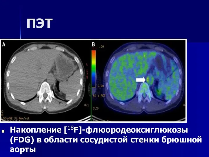 ПЭТ Накопление [18F]-флюородеоксиглюкозы (FDG) в области сосудистой стенки брюшной аорты