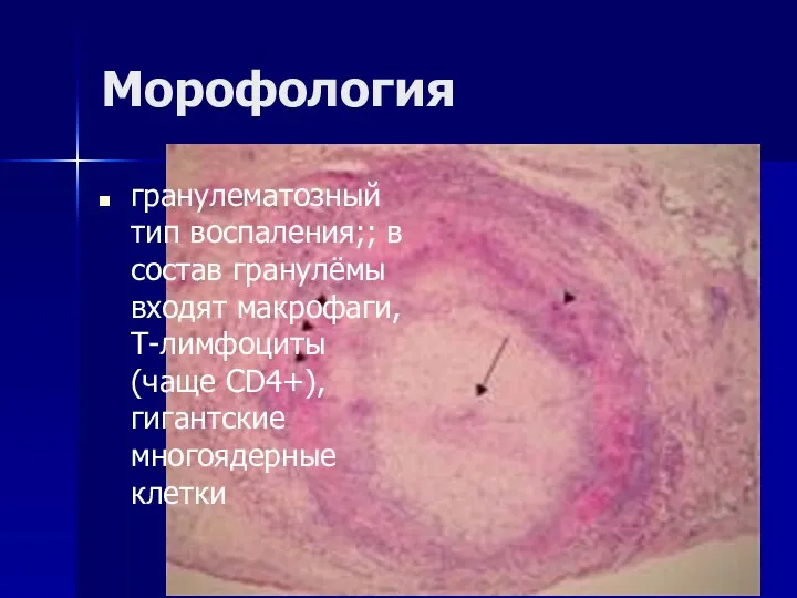 Морофология гранулематозный тип воспаления;; в состав гранулёмы входят макрофаги, Т-лимфоциты (чаще CD4+), гигантские многоядерные клетки